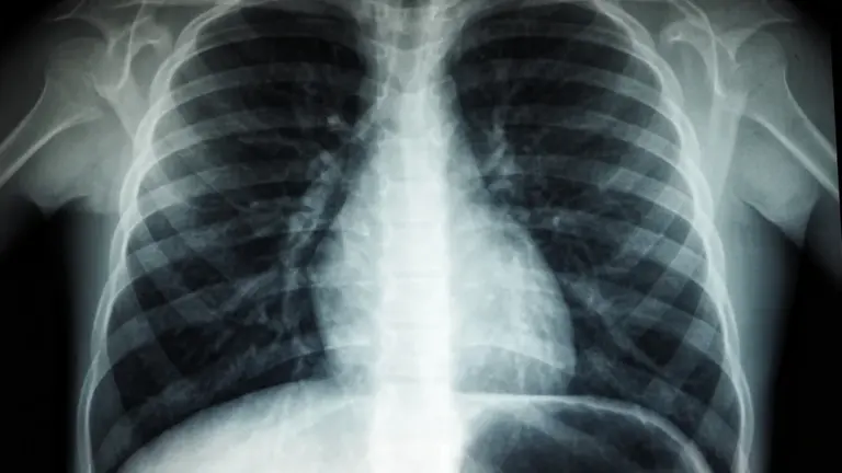 New heart and lung health checks roll out in Tayside, Glasgow, Grampian